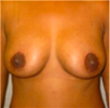 Breast Lift After Photo by Mariam Awada, MD, FACS; Southfield, MI - Case 40156