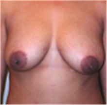 Breast Lift Before Photo by Mariam Awada, MD, FACS; Southfield, MI - Case 40156