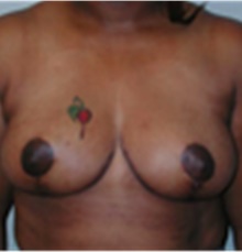 Breast Lift After Photo by Mariam Awada, MD, FACS; Southfield, MI - Case 40157