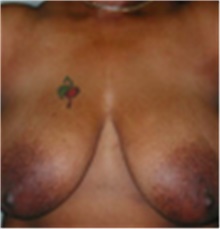 Breast Lift Before Photo by Mariam Awada, MD, FACS; Southfield, MI - Case 40157