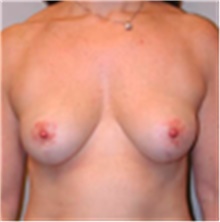 Breast Lift Before Photo by Mariam Awada, MD, FACS; Southfield, MI - Case 40160