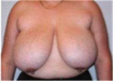 Breast Reduction Before Photo by Mariam Awada, MD, FACS; Southfield, MI - Case 40171