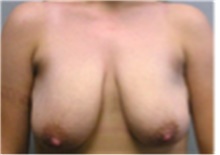 Breast Reduction Before Photo by Mariam Awada, MD, FACS; Southfield, MI - Case 40173