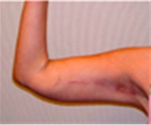 Arm Lift After Photo by Mariam Awada, MD, FACS; Southfield, MI - Case 40199