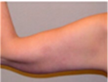 Arm Lift After Photo by Mariam Awada, MD, FACS; Southfield, MI - Case 40200
