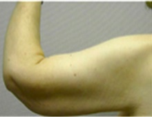 Arm Lift After Photo by Mariam Awada, MD, FACS; Southfield, MI - Case 40201