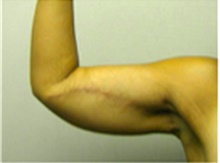 Arm Lift After Photo by Mariam Awada, MD, FACS; Southfield, MI - Case 40202