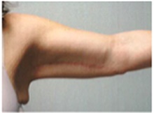 Arm Lift After Photo by Mariam Awada, MD, FACS; Southfield, MI - Case 40203