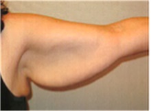 Arm Lift Before and After Photos