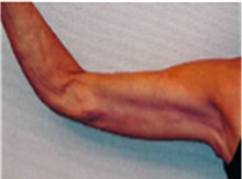 Arm Lift After Photo by Mariam Awada, MD, FACS; Southfield, MI - Case 40205