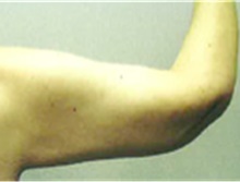 Arm Lift After Photo by Mariam Awada, MD, FACS; Southfield, MI - Case 40208