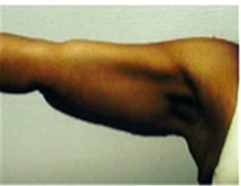 Arm Lift After Photo by Mariam Awada, MD, FACS; Southfield, MI - Case 40209