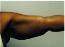 Arm Lift After Photo by Mariam Awada, MD, FACS; Southfield, MI - Case 40210