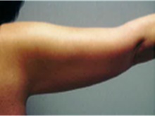 Arm Lift After Photo by Mariam Awada, MD, FACS; Southfield, MI - Case 40214
