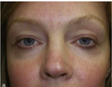 Brow Lift After Photo by Mariam Awada, MD, FACS; Southfield, MI - Case 40223