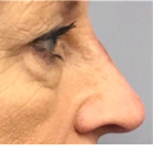 Dermal Fillers After Photo by Mariam Awada, MD, FACS; Southfield, MI - Case 40263