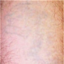Tattoo Removal After Photo by Mariam Awada, MD, FACS; Southfield, MI - Case 40293