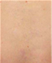 Tattoo Removal After Photo by Mariam Awada, MD, FACS; Southfield, MI - Case 40294