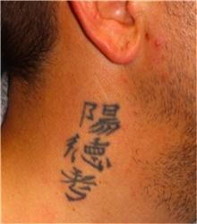 Tattoo Removal Before Photo by Mariam Awada, MD, FACS; Southfield, MI - Case 40297