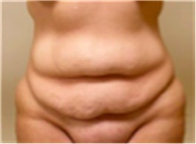Tummy Tuck Before Photo by Mariam Awada, MD, FACS; Southfield, MI - Case 40312