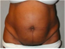 Tummy Tuck Before Photo by Mariam Awada, MD, FACS; Southfield, MI - Case 40313
