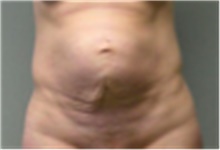 Tummy Tuck Before Photo by Mariam Awada, MD, FACS; Southfield, MI - Case 40315