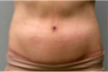 Tummy Tuck After Photo by Mariam Awada, MD, FACS; Southfield, MI - Case 40318