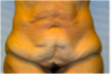 Tummy Tuck Before Photo by Mariam Awada, MD, FACS; Southfield, MI - Case 40318