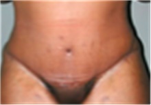 Tummy Tuck After Photo by Mariam Awada, MD, FACS; Southfield, MI - Case 40321