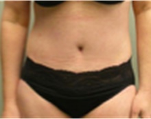Tummy Tuck After Photo by Mariam Awada, MD, FACS; Southfield, MI - Case 40332
