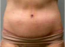 Tummy Tuck After Photo by Mariam Awada, MD, FACS; Southfield, MI - Case 40333