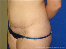 Tummy Tuck After Photo by Evan Sorokin, MD; Cherry Hill, NJ - Case 36284