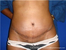 Tummy Tuck After Photo by Evan Sorokin, MD; Cherry Hill, NJ - Case 36358