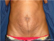 Tummy Tuck Before Photo by Evan Sorokin, MD; Cherry Hill, NJ - Case 36358