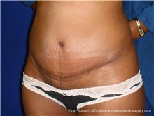 Tummy Tuck After Photo by Evan Sorokin, MD; Cherry Hill, NJ - Case 36358