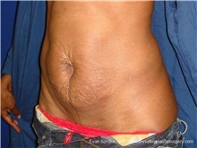 Tummy Tuck Before Photo by Evan Sorokin, MD; Cherry Hill, NJ - Case 36358