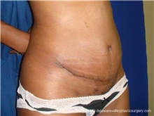 Tummy Tuck After Photo by Evan Sorokin, MD; Cherry Hill, NJ - Case 36358