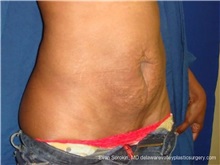 Tummy Tuck Before Photo by Evan Sorokin, MD; Cherry Hill, NJ - Case 36358