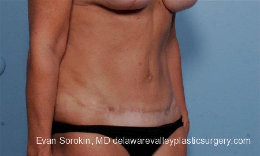 Tummy Tuck New Jersey  Abdominoplasty Philadelphia