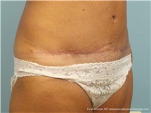 Tummy Tuck After Photo by Evan Sorokin, MD; Cherry Hill, NJ - Case 36361
