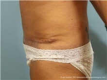 Tummy Tuck After Photo by Evan Sorokin, MD; Cherry Hill, NJ - Case 36361