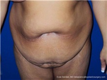Tummy Tuck Before Photo by Evan Sorokin, MD; Cherry Hill, NJ - Case 36365