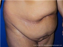 Tummy Tuck Before Photo by Evan Sorokin, MD; Cherry Hill, NJ - Case 36365