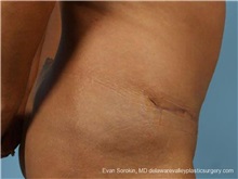 Tummy Tuck After Photo by Evan Sorokin, MD; Cherry Hill, NJ - Case 36365