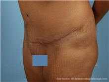Tummy Tuck After Photo by Evan Sorokin, MD; Cherry Hill, NJ - Case 36365