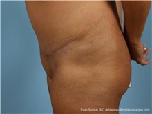 Tummy Tuck After Photo by Evan Sorokin, MD; Cherry Hill, NJ - Case 36365