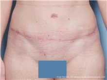 Tummy Tuck After Photo by Evan Sorokin, MD; ,  - Case 36368