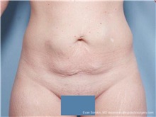 Tummy Tuck Before Photo by Evan Sorokin, MD; ,  - Case 36368