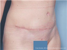 Tummy Tuck After Photo by Evan Sorokin, MD; ,  - Case 36368