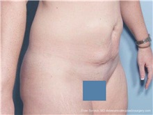 Tummy Tuck Before Photo by Evan Sorokin, MD; ,  - Case 36368